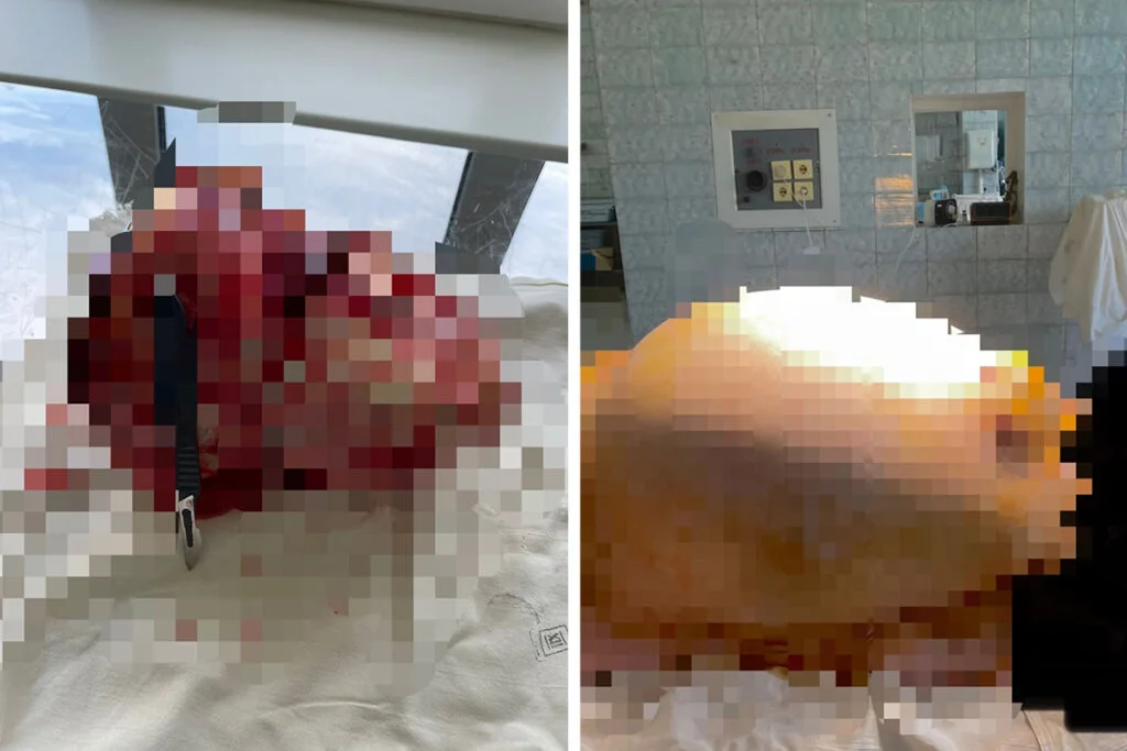 В Стерлитамаке женщине удалили гигантскую опухоль брюшной полости