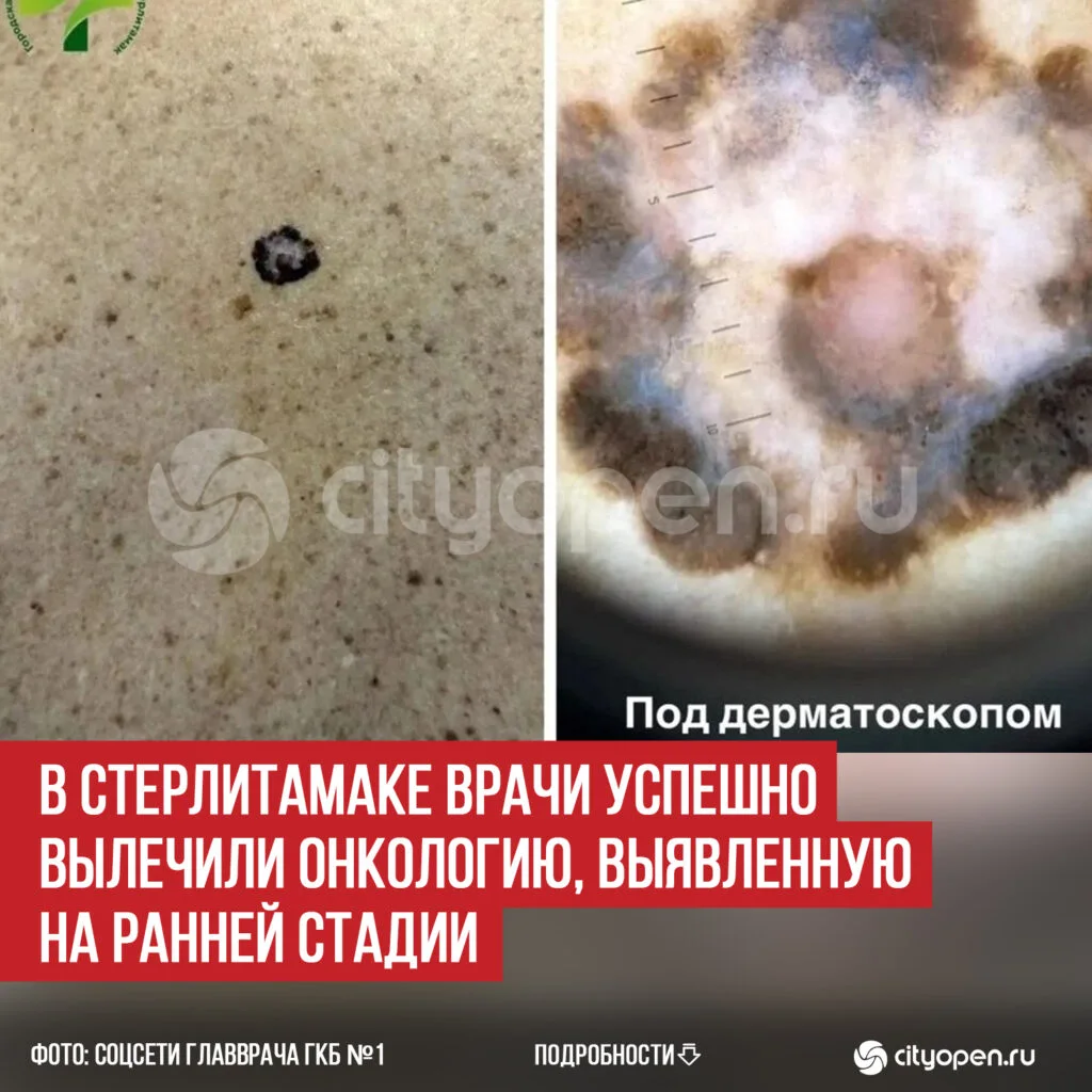 В Стерлитамаке врачи успешно вылечили онкологию, выявленную на ранней стадии