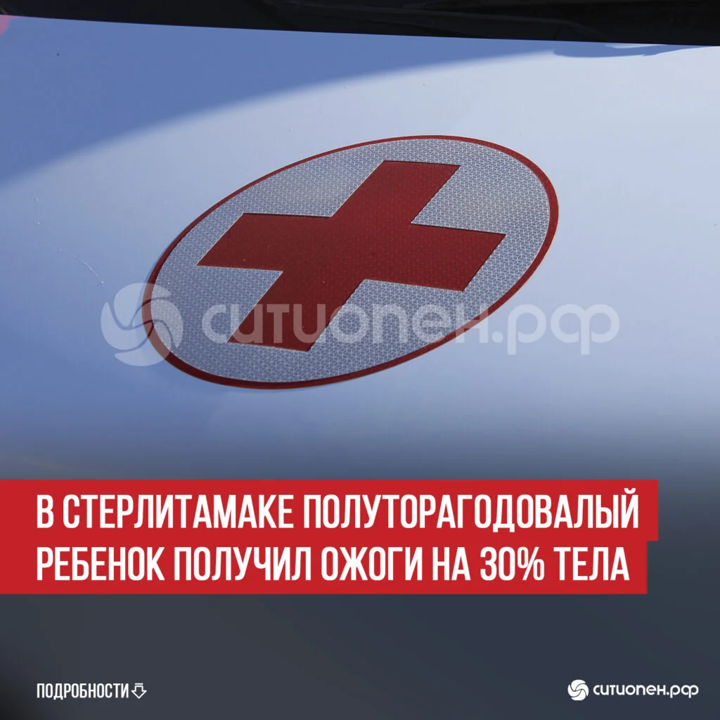 В Стерлитамаке полуторагодовалый ребенок получил ожоги на 30% тела