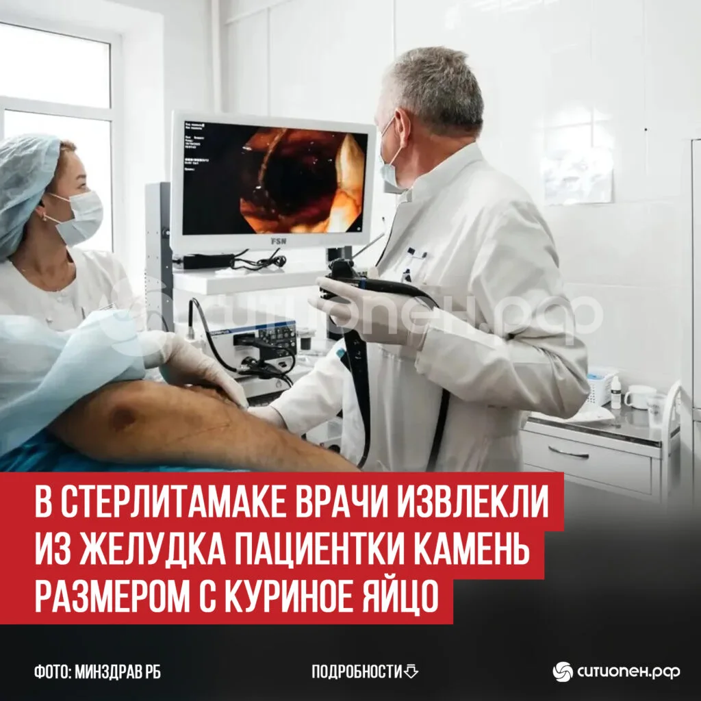 В Стерлитамаке врачи извлекли из желудка пациентки камень размером с куриное яйцо