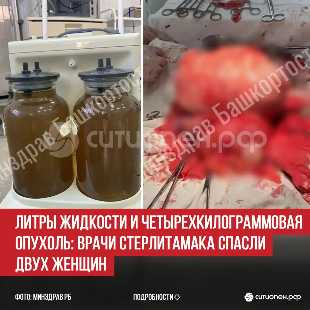 Литры жидкости и четырехкилограммовая опухоль: врачи Стерлитамака спасли двух женщин
