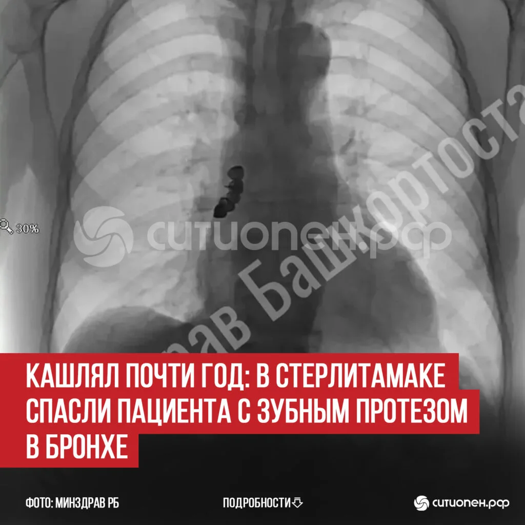 Кашлял почти год: в Стерлитамаке спасли пациента с зубным протезом в бронхе